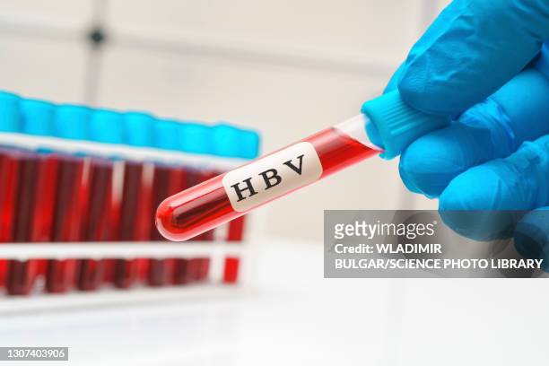 hepatitis b virus blood test, conceptual image - hepatitis virus bildbanksfoton och bilder
