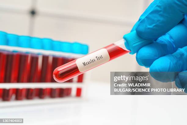 measles blood test, conceptual image - measles hand stock pictures, royalty-free photos & images