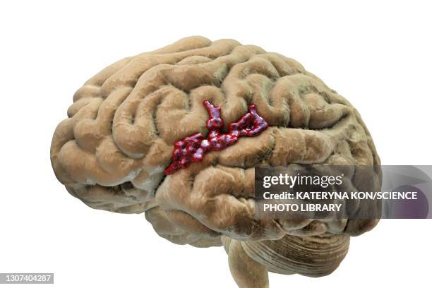 brain haemorrhage, illustration - hemorrhage stock pictures, royalty-free photos & images