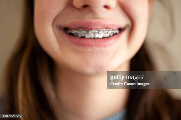 close up of braces on teeth of a teen girl against blank wall - blue braces stock pictures, royalty-free photos & images