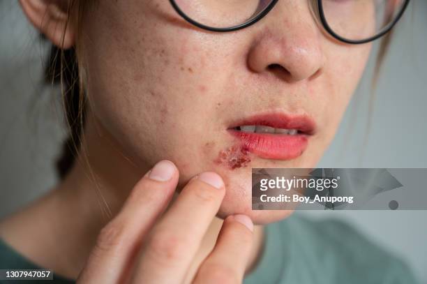 close up of woman feeling pain from herpes labialis occur on her lower lip. - cold sore stock-fotos und bilder