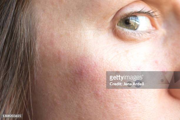 woman with acne closeup skin with pimples on face - blackhead stock pictures, royalty-free photos & images
