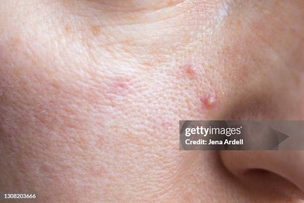 oily skin acne closeup with pimples on face - unvollkommenheit stock-fotos und bilder