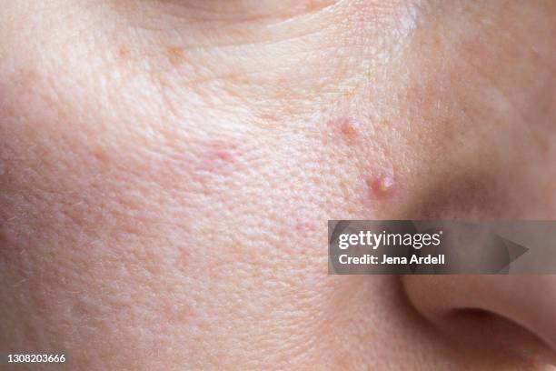 oily skin acne closeup with pimples on face - very ugly women imagens e fotografias de stock