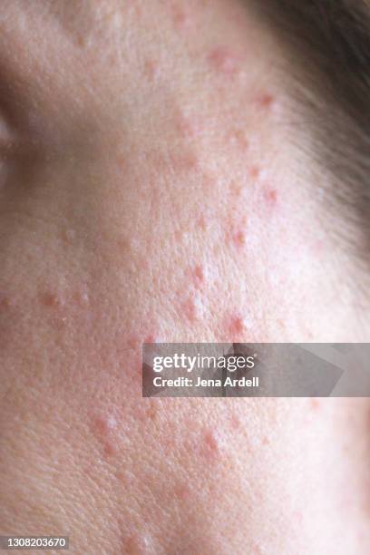 pimples, zits, acne on face - blackheads photos et images de collection