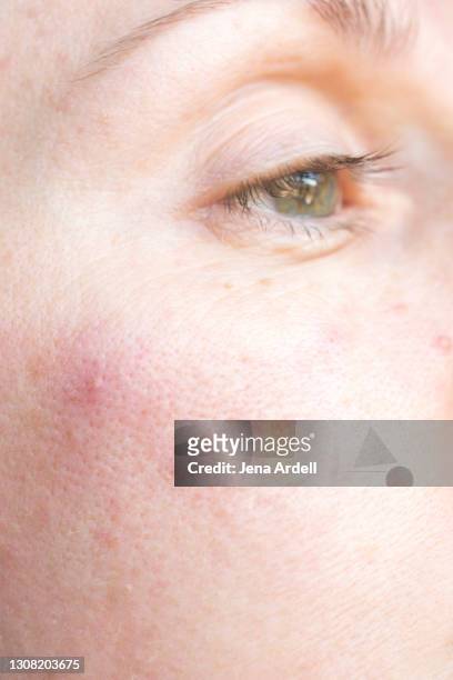 pimple on cheek, woman with pimples, adult acne - no make up stockfoto's en -beelden