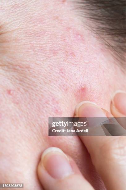 woman with acne, adult acne, woman touching face with pimples - oily skin stock pictures, royalty-free photos & images