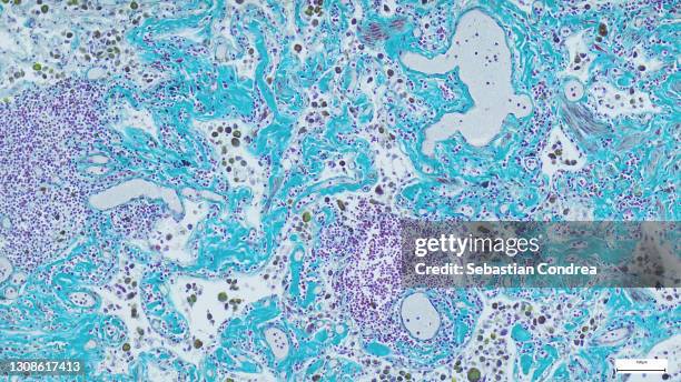 slide demonstrating breast tissue with ductal carcinoma. histopathology on the microscope. immunofluorescent photomicrograph, organs samples, histological examination, - blood stain stock-fotos und bilder