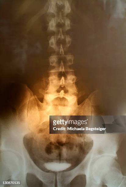 x-ray of backbone - columna vertebral stock-fotos und bilder