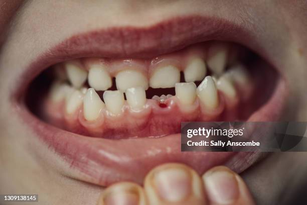 Child Showing Missing Tooth High-Res Stock Photo - Getty Images Child Showing Missing Tooth High-Res Stock Photo - Getty Images