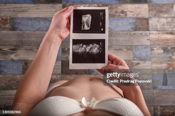 female body and health , gynaecology uterus test - quisto nos ovários imagens e fotografias de stock