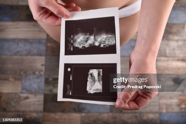 female body and health , gynaecology uterus test - ovarian cyst stock pictures, royalty-free photos & images