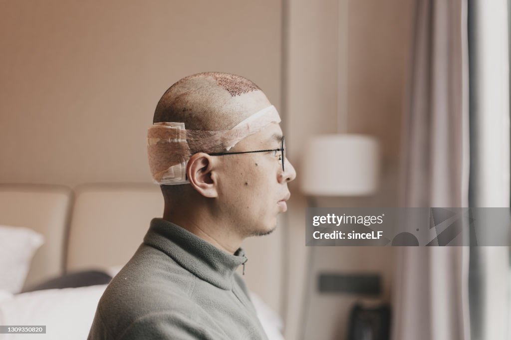 Asiatische Männer, die gerade eine Haartransplantation hatten, sind in der Station