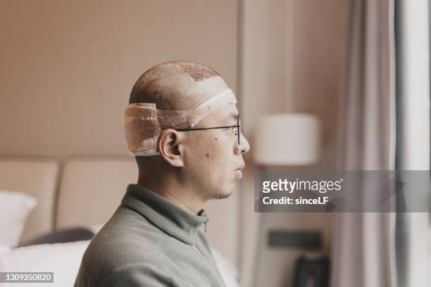 asiatische männer, die gerade eine haartransplantation hatten, sind in der station - haartransplantation stock-fotos und bilder