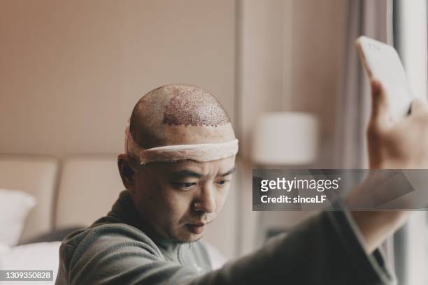 asiatische männer, die gerade eine haartransplantation hatten, sind in der station - haartransplantation stock-fotos und bilder