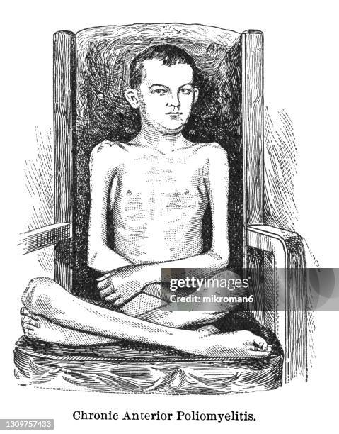 old engraved illustration of the symptoms and progression of polio infection, chronic anterior poliomyelitis - polio stockfoto's en -beelden