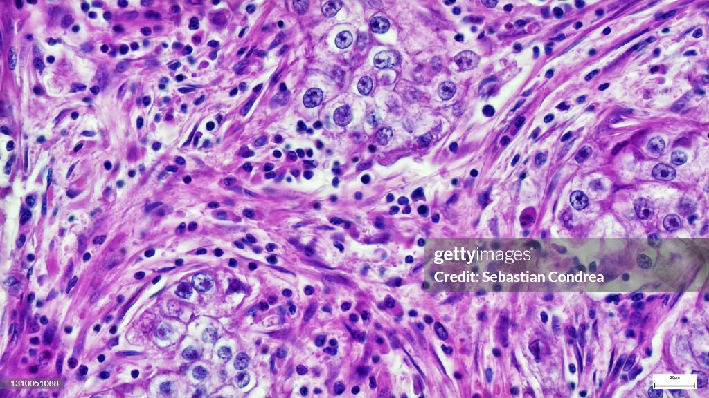 Microscope of Adenoid cystic carcinoma, rare type of cancer exist in many different body sites. This tumor occurs in the salivary glands,