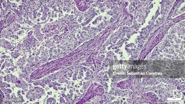 micrograph of peritoneal mesothelioma. immunofluorescent photomicrograph, organs samples, histological examination, histopathology on the microscope - fettgewebezelle stock-fotos und bilder