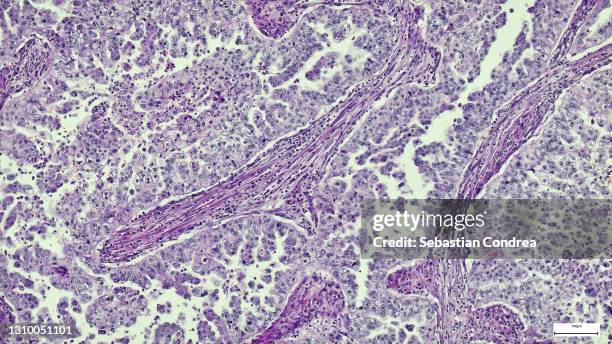 micrograph of peritoneal mesothelioma. immunofluorescent photomicrograph, organs samples, histological examination, histopathology on the microscope - liver cell stock pictures, royalty-free photos & images