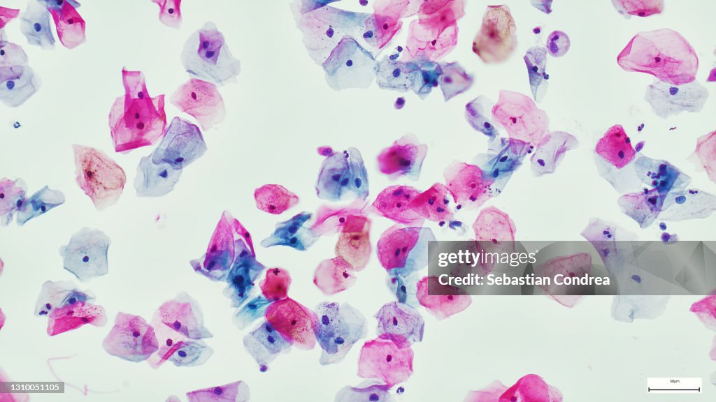 Squamous epithelial cells of human cervix under the microscope view. Pap smear test is a procedure to test for cervical cancer in women