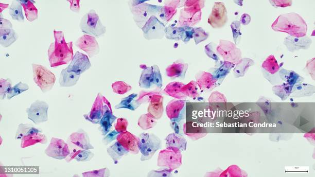 squamous epithelial cells of human cervix under the microscope view. pap smear test is a procedure to test for cervical cancer in women - virus del papilloma umano foto e immagini stock