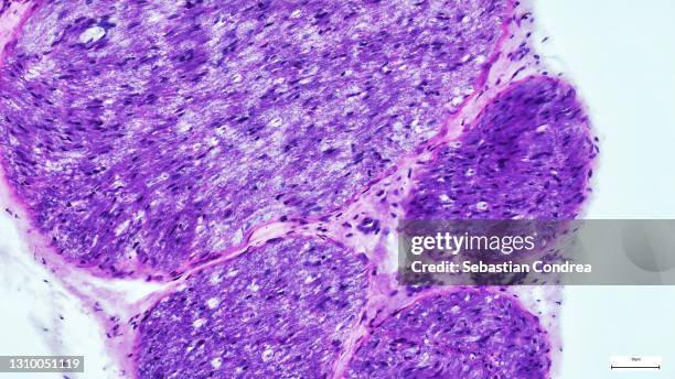 lobular breast cancer, immunofluorescent photomicrograph, organs samples, histological examination, histopathology on the microscope - ヘマトキシリンエオジン染色 ストックフォトと画像