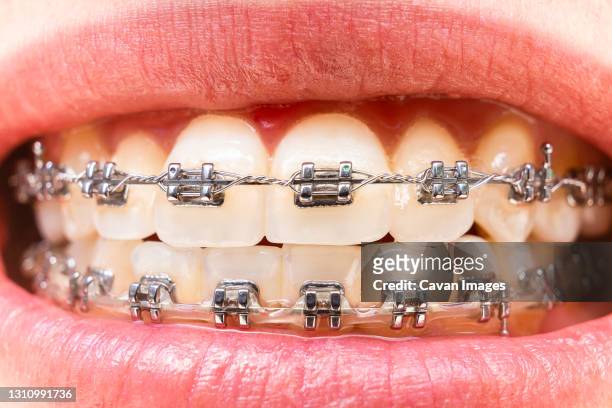 foreground teeth with braces with traces of food. dental care photo. smile woman with orthodontic accessories. orthodontic treatment - adult retainer ストックフォトと画像