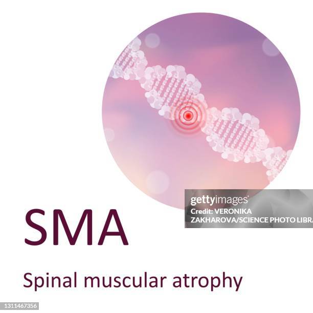 spinal muscular atrophy, illustration - atrophy stock illustrations