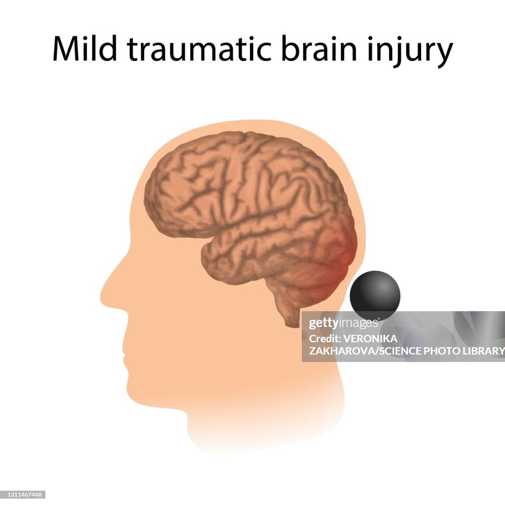 Mild Traumatic Brain Injury Illustration High-Res Vector Graphic