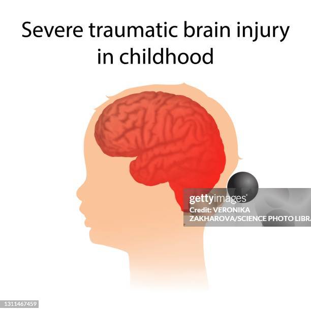 Traumatic Brain Injury Photos and Premium High Res Pictures - Getty Images