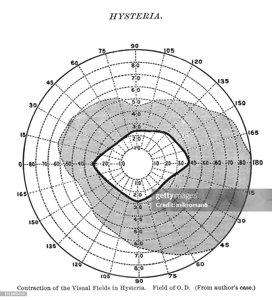 Contraction Visual Field Old Engraved Illustration Of Contraction Of The Visual Fields In ...