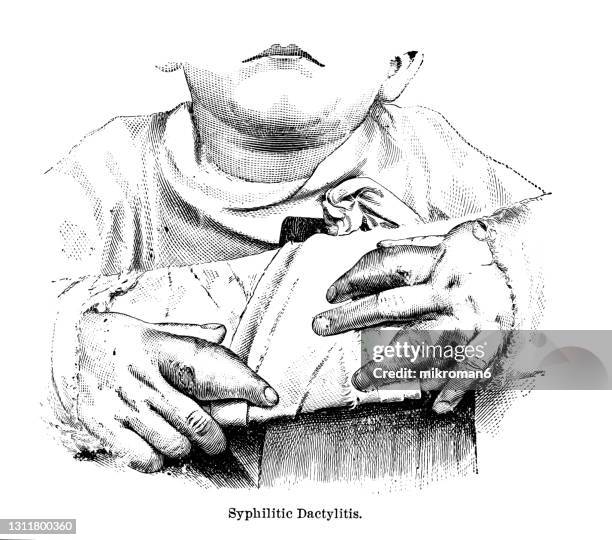 Syphilis Old 643 Syphilis Images Stock Photos, High-Res Pictures, and Images - Getty ...