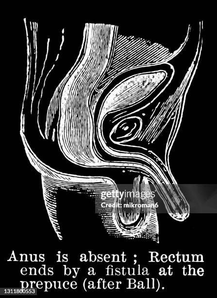 old engraved illustration of the anus is absent; rectum ends by a fistula at the prepuce (after ball) - anus foto e immagini stock