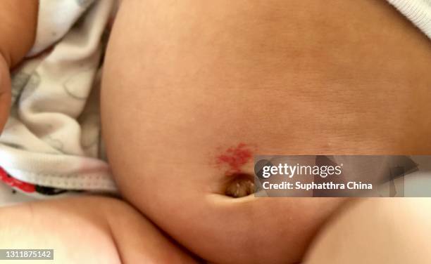 red spot on baby skin - chubby asian girl stock-fotos und bilder