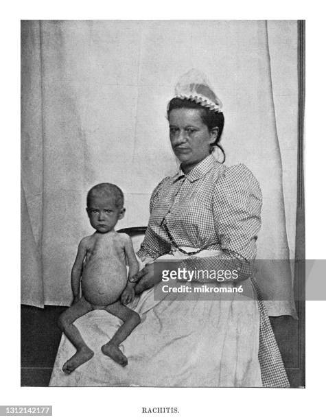 old engraved illustration of rachitic child and nurse - birth deformities stock pictures, royalty-free photos & images