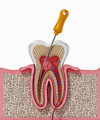 3D illustration of root canal treatment