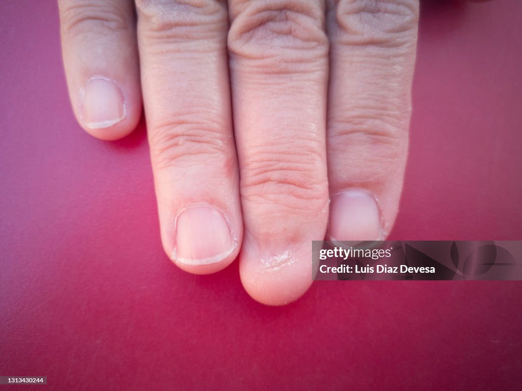 Finger without nail on hand