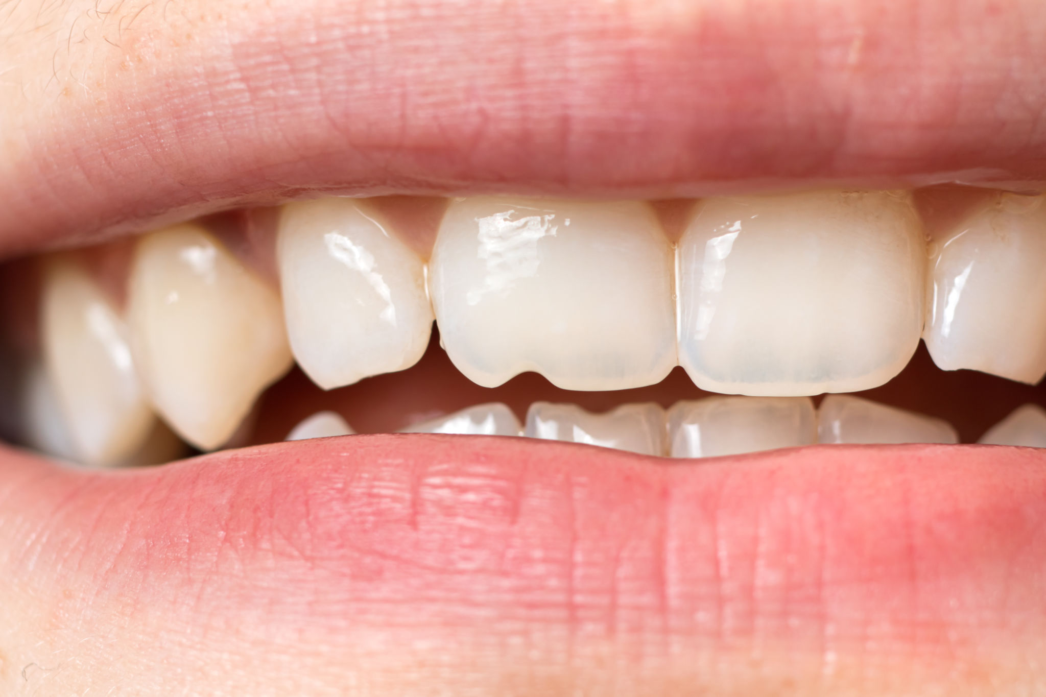 weather effects on teeth