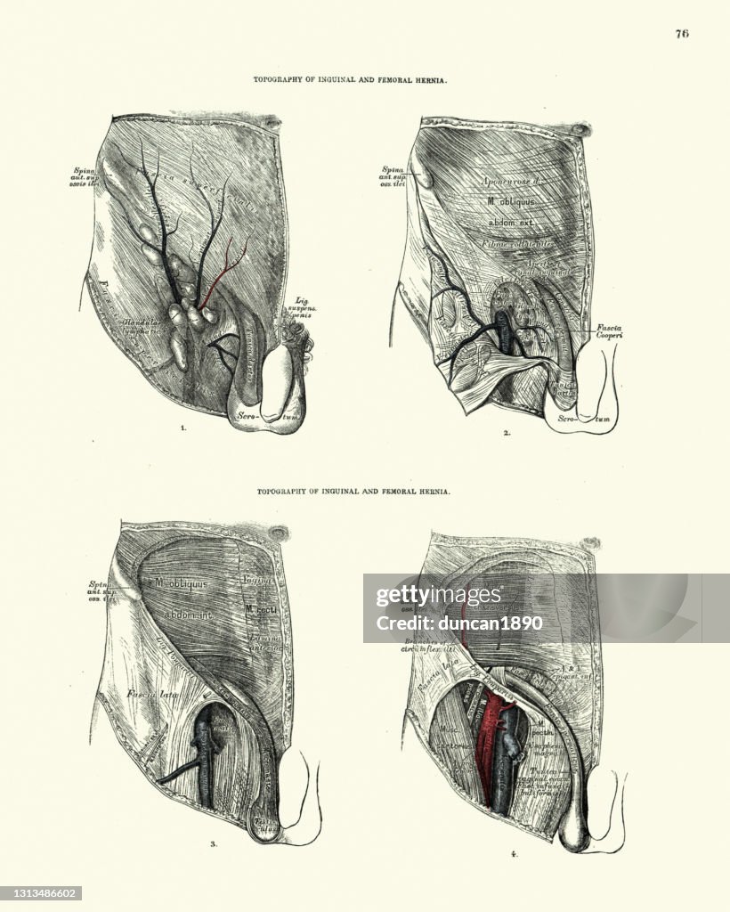 Anatomie, Topographie de l’hernie inguinale et fémorale, dessin anatomique victorien du XIXe siècle