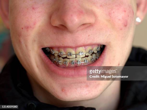 teen boy with acne and braces - braces man ストックフォトと画像