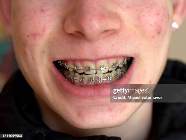 teen boy with acne and braces - painful lips stock pictures, royalty-free photos & images