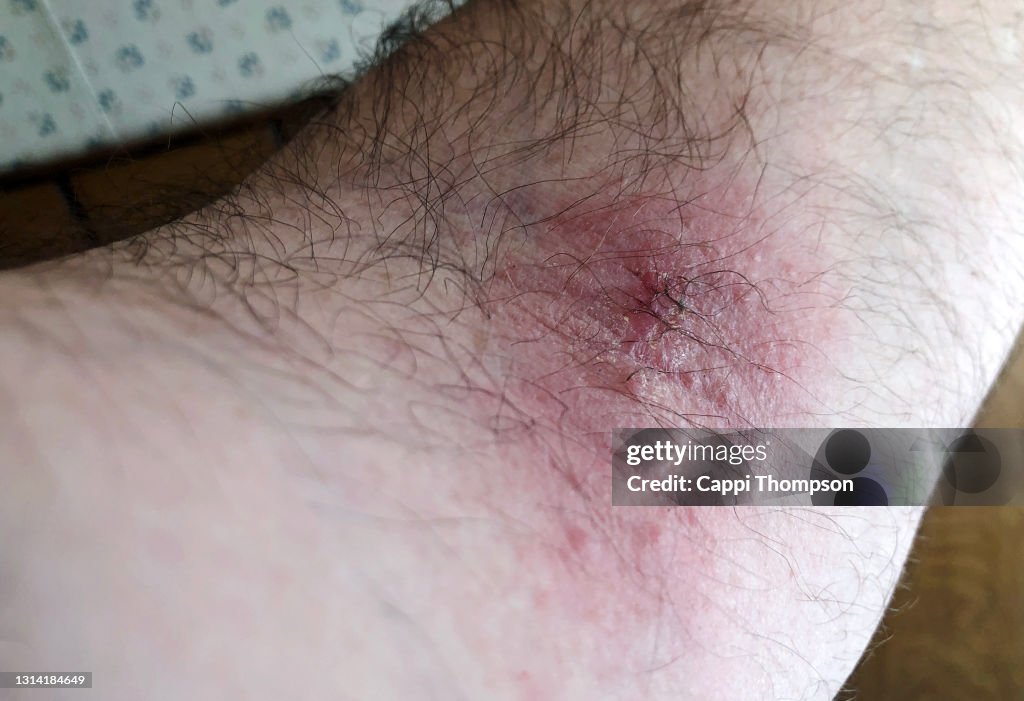 Poison Ivy Rash on man's arm