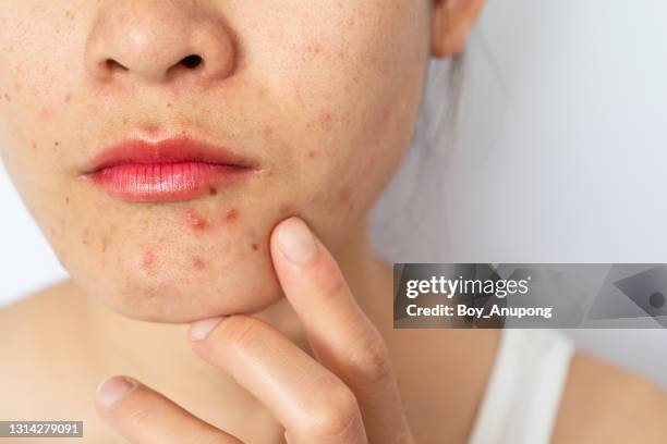 headshot of woman face with problems of acne inflamed (papule and pustule) occur on her skin. - pimple stockfoto's en -beelden