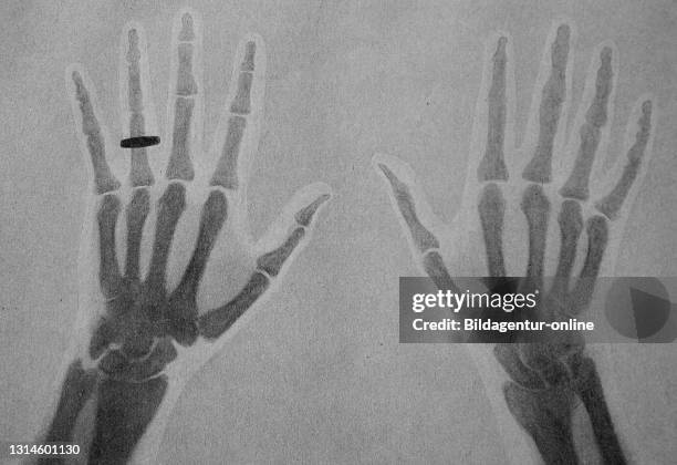 First Radiographers Hand 30 Ca 1 Jahrhundert Stock Photos, High-Res Pictures, and Images - Getty ...