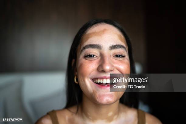 portrait of a young woman with vitiligo at home - skin condition stock pictures, royalty-free photos & images