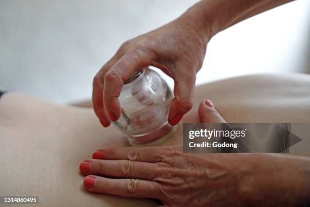 Traditional chinese medecine. Cupping therapy. Woman receving fire cupping. France.