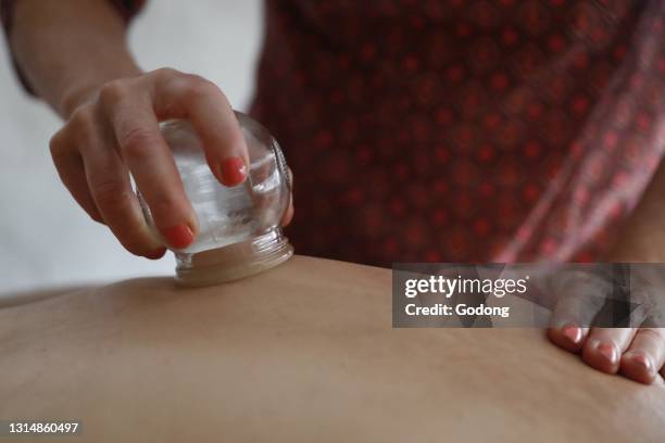 Traditional chinese medecine. Cupping therapy. Woman receving fire cupping. France.