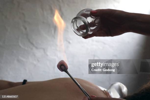 Traditional chinese medecine. Cupping therapy. Woman receving fire cupping. France.