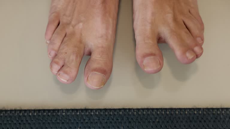 Interlinked Toes 95 Fused Toes Stock Videos, Footage, & 4K Video Clips - Getty Images