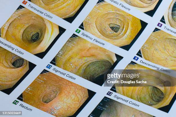 colonoscopy images of small and large bowels - anal stock pictures, royalty-free photos & images